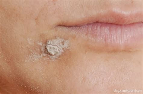 How to Treat Acne With Potatoes in 5 Days
