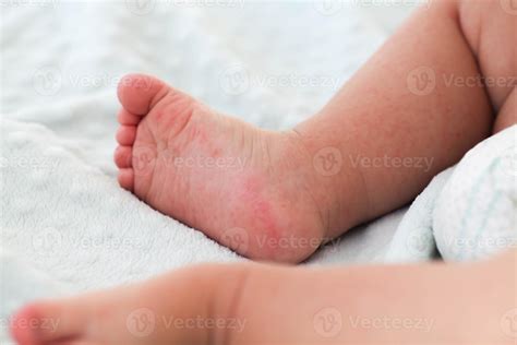 A small child with a red rash on the leg sits on the bed. Children is