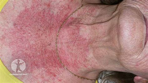 case  year   chest rash