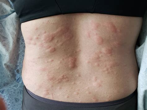What Causes Me to Breakout into Hives? - Arlington Dermatology