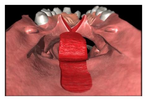 elevation  superiorly based pharyngeal flap  scientific