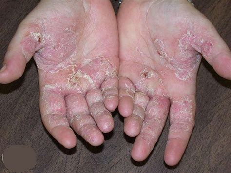 eczema hand face baby  symptoms treatment