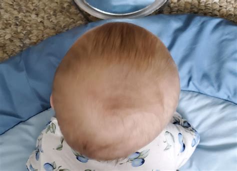 flat head syndrome adults pictures