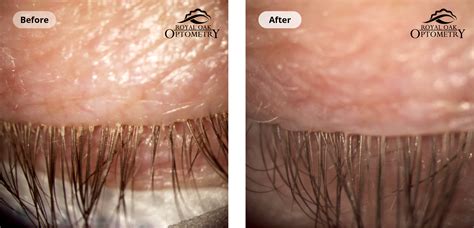 Two images of the same eye before and after ZEST treatment. - Royal Oak ...