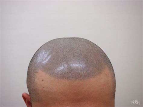 ヘアタトゥーの施術例写真を見る | ビフォー・アフター | SPJ