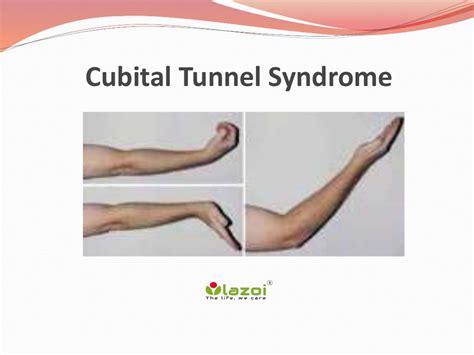 Cubital tunnel syndrome