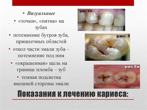 Общее лечение кариеса зубов - презентация онлайн