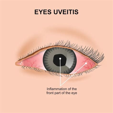 uveitis  fairfax va fairfax cataract  retina specialist