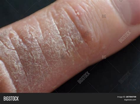 Hand Dermatitis. Hand Image & Photo (Free Trial) | Bigstock