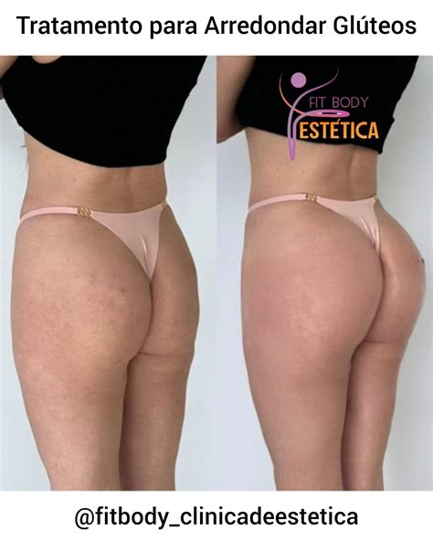 Tratamento para Arredondar Glúteos com Preenchimento