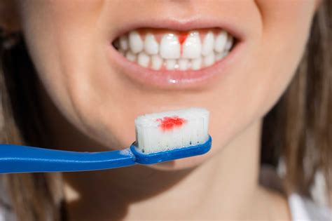9 Ways To Stop Bleeding Gums From Brushing Teeth