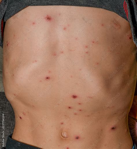 Chickenpox on the body of a child, Severe chicken pox crusts on rashes ...