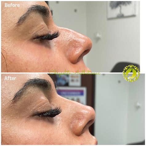 Before & After Gallery - Houston, TX: Chrysolite Aesthetics