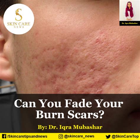 Effective Ways to Fade Burn Scars and Restore Your Skin's Appearance - Hunter Games Magazine