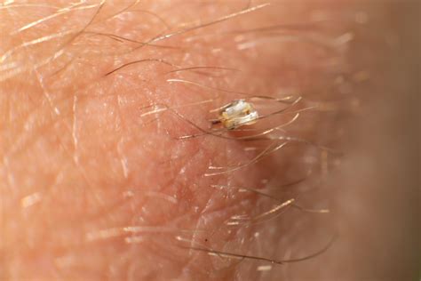 Swollen bee sting site, redness on the skin from a bee sting. 14377764