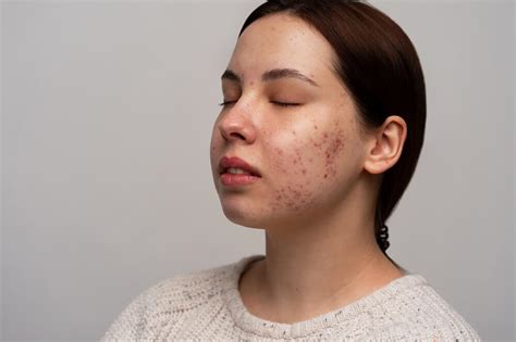 Causes Of Acne And How To Get Rid Of Acne - IPAL CLINIC