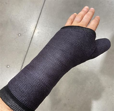 UCL ligament reattachment Movement is almost completely eliminated due