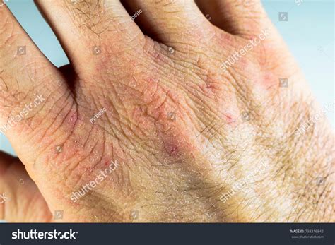 close view dry cracked hand knuckles stock photo  shutterstock