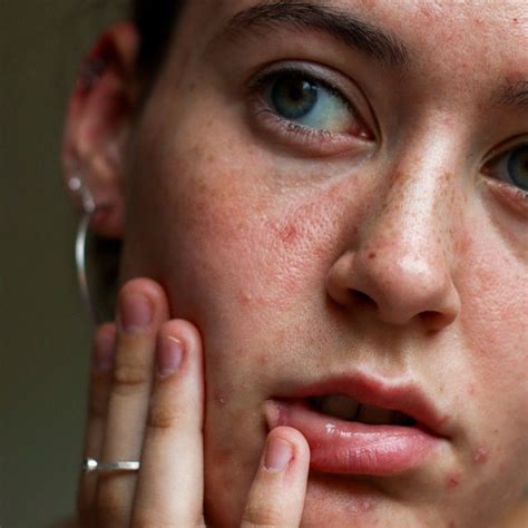 Repair your skin from the inside out - healing a damaged skin barrier