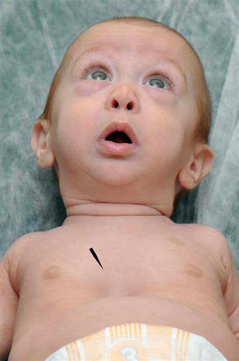 Pierre Robin syndrome causes, symptoms, prognosis and treatment