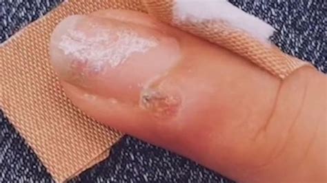 Woman warns others how manicure may have given her cancer | FOX 11 Los ...