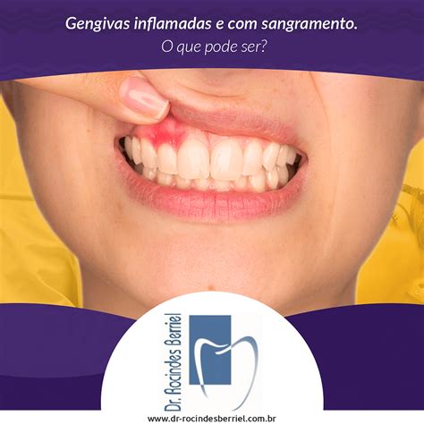 Oq E Bom Para Gengiva Inchada