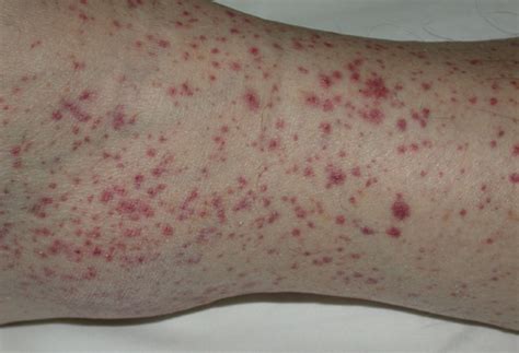 Senile Purpura