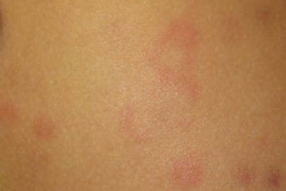 Hives | Symptoms, Causes, Treatment | Cumberland Skin