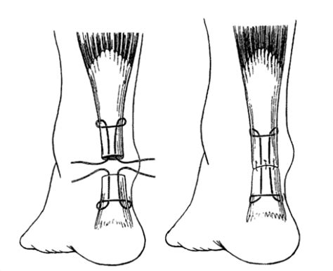 achilles tendon surgery  health advisor
