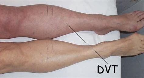 deep vein thrombosis dvt northwest vein aesthetic center