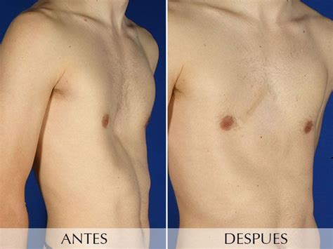 Severe Pectus Excavatum