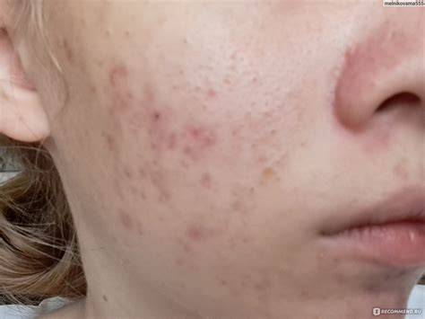 Крем ARAVIA Корректор азелаиновый Azelaic Correcting Cream - «Крем ...
