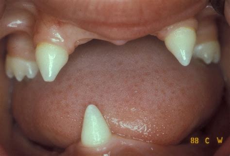 Rx Pics: ECTODERMAL DYSPLASIA