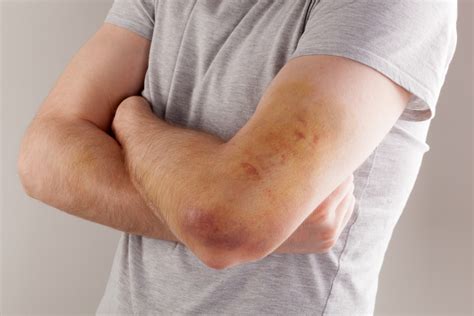 What is hemophilia and the Causes of Hemophilia? - Of W Now