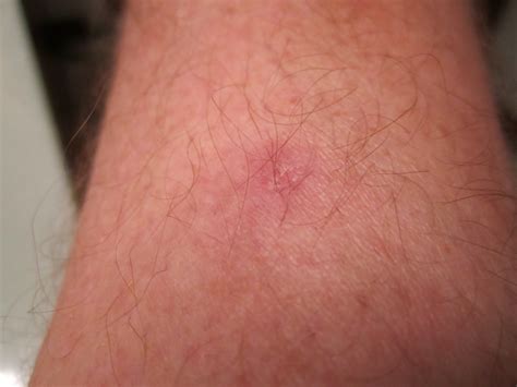Amelanotic Melanoma Scalp