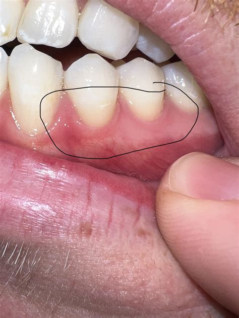 Does this look like gingivitis? : r/askdentists