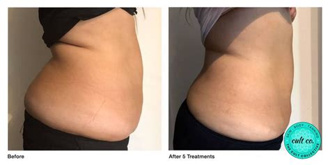 Ultrasound-fat-cavitation-before-after-2 | The Cult Collective