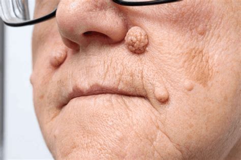 Dermal Nevus