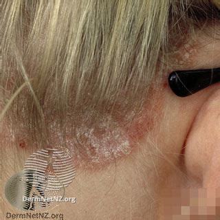 Psoriasis – RefHelp