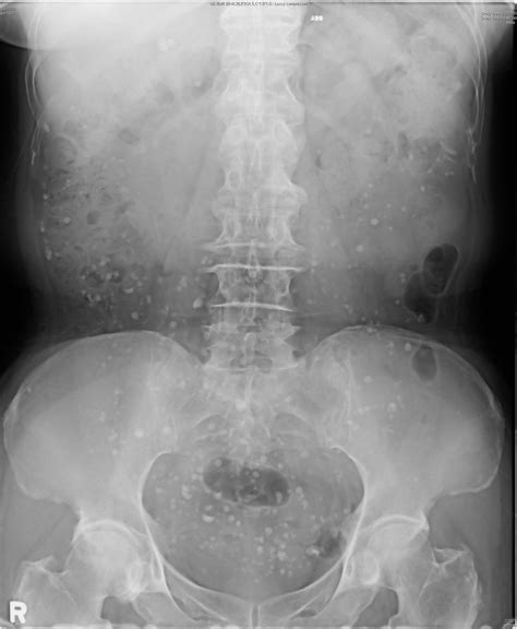 Patients are reacting to their abnormal abdomen x ray findings 12