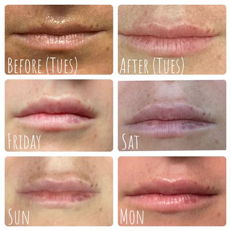 Lip filler swelling/settling progress (1 week. 1 mL Juvederm Ultra Plus