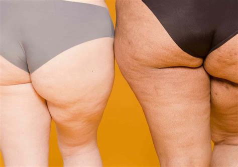 What is cellulite? And what causes it? — Moody Sisters Skincare