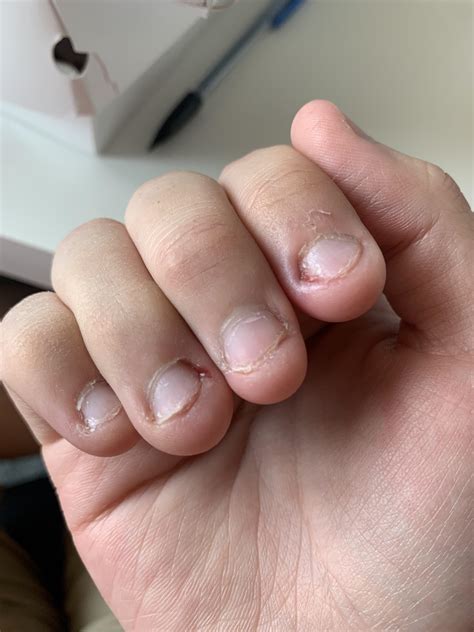 Where do I begin with multiple ingrown fingernails? This has sadly