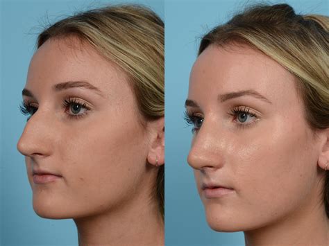 rhinoplasty  rhinoplasty nose surgery nose  xxx