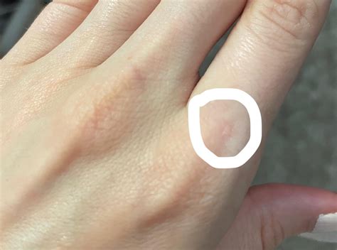 Is this an early stage wart on my hand? : r/DermatologyQuestions