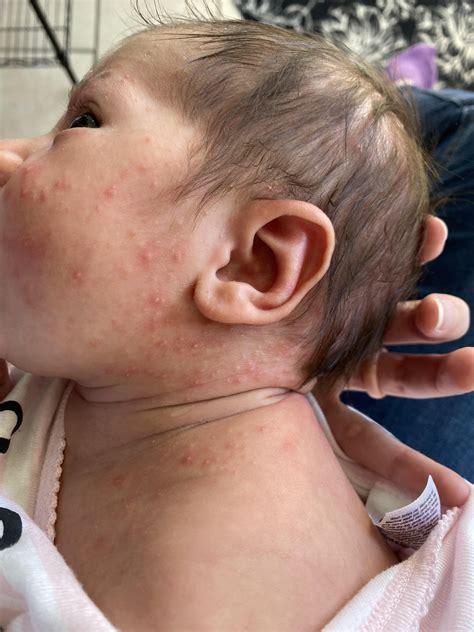 how to help baby acne 3