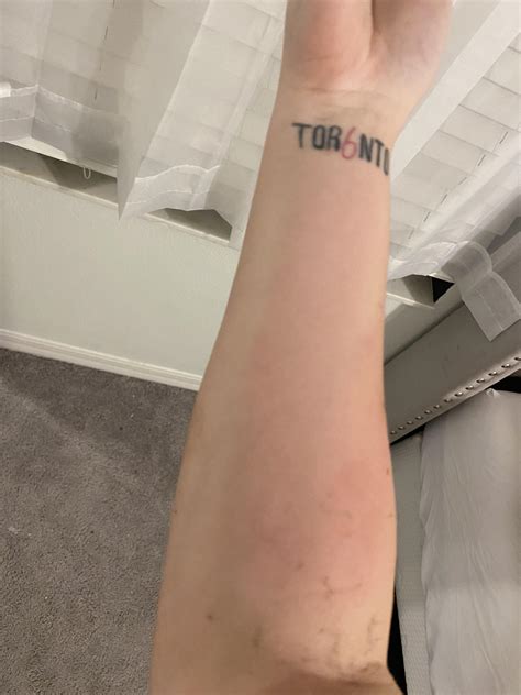 Blood Clot In Forearm