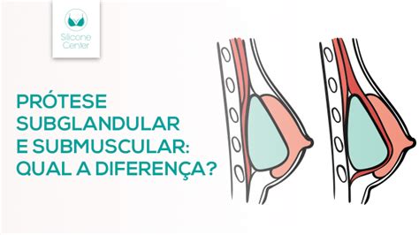 Silicone Submuscular Antes E Depois - Prótese subglandular e submuscular: qual a diferença? - Blog Silicone ...
