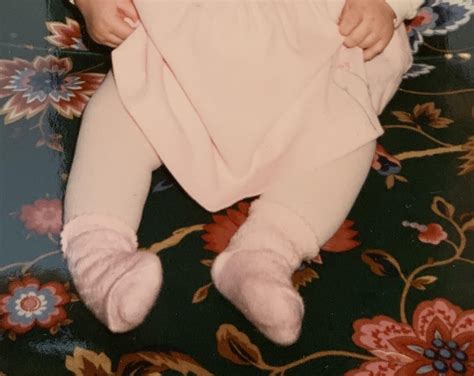 My clubfoot journey to becoming a PT *pic of my cute little baby