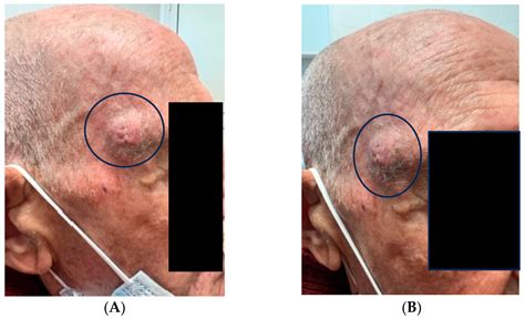 Poorly Differentiated Cutaneous Squamous Cell Carcinoma (cSCC) or